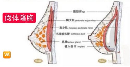 温州医科大学附属第二医院整形科假体隆胸