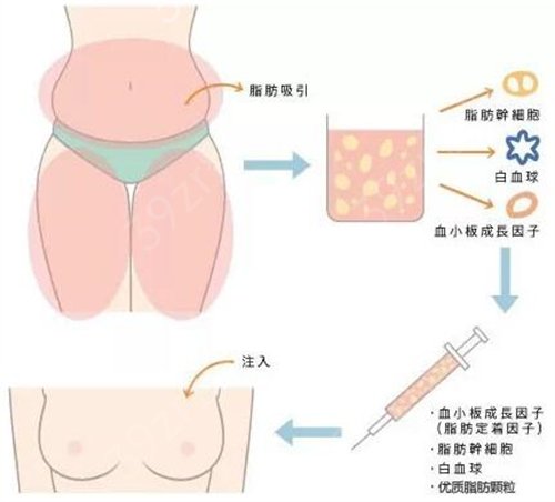 南华大学附属医院整形科隆胸