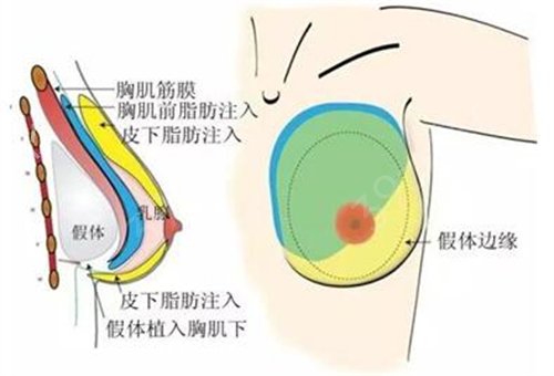 南华大学附属医院整形科隆胸