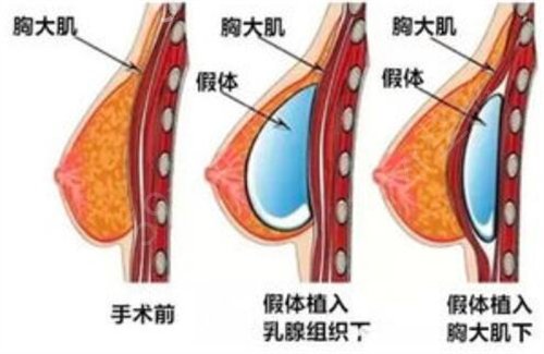 2020信阳市中心医院整形科价格表，附隆胸真人案例