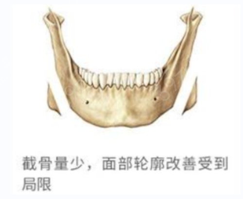 北京处磨骨怎么样？磨骨前后差别真不是一般的大