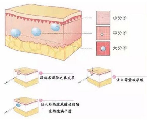 九江市人民医院整形外科价格表明细+玻尿酸垫下巴真实经历分享