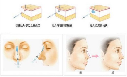 九江市人民医院整形外科价格表明细+玻尿酸垫下巴真实经历分享