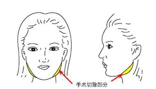 上海韩镜金一秀面部轮廓案例