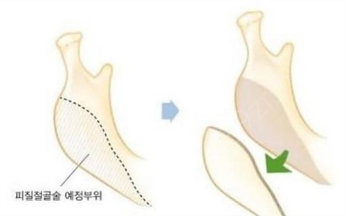 上海韩镜金一秀面部轮廓案例