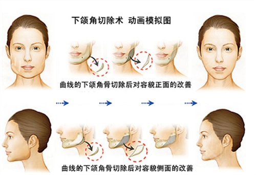 赣南医学院第一附属医院整形美容科下颌角案例