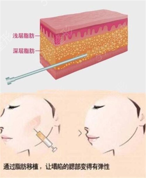 哈医大一院整形外科吕远东怎么样?看自体脂肪填充全脸*果如何