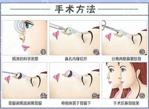 广西医科大学第（一）附属医院整形科隆鼻