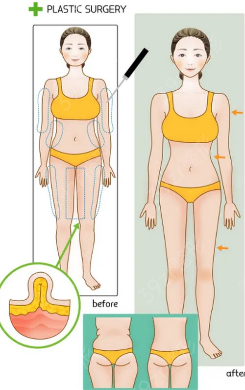 长沙梵童整形价格表，附真人抽脂案例
