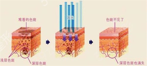 西安航天总医院整形科价格表火爆登场，附激光祛斑案例图