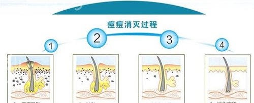 济南千佛山医院整形科价格表全新出炉，附激光祛痘案例