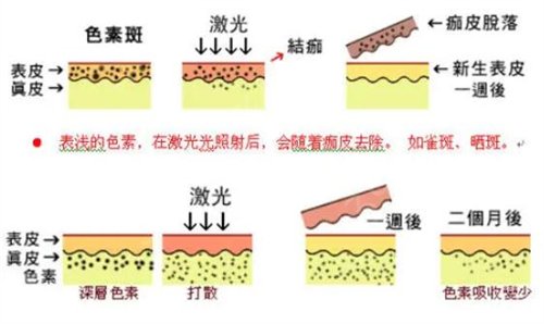 兰州中泰激光整形美容中心价格表+激光祛斑过程分享