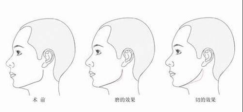 上海交通大学附属第六人民医院整形外科价格表+下颌角磨骨日记