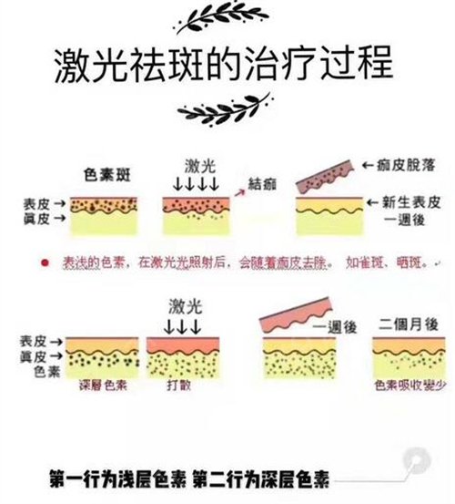 2019湖南省人民医院整形科价目表(价格表）_谭军激光祛斑案例