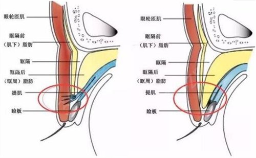 交大一附院白转丽双眼皮好吗？价格表及术后*果分享