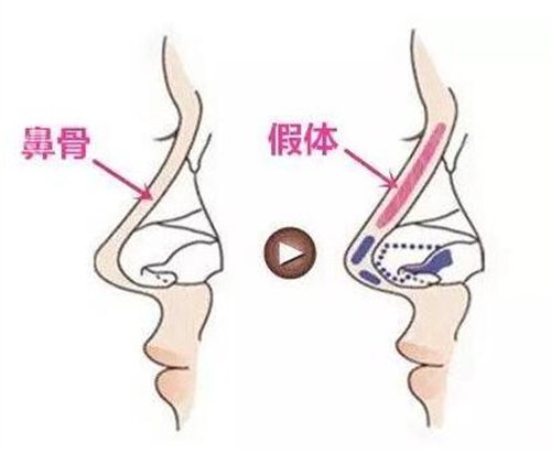 李信锋鼻子做得好吗?看我2个月鼻整形恢复情况