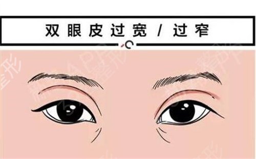 杭州*连天美姜鑫利做双眼皮好吗?附双眼皮修复案例展示