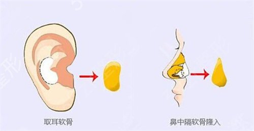 梁晓健做鼻子多少钱?怎样?分享医生个人隆鼻案例术后反馈图