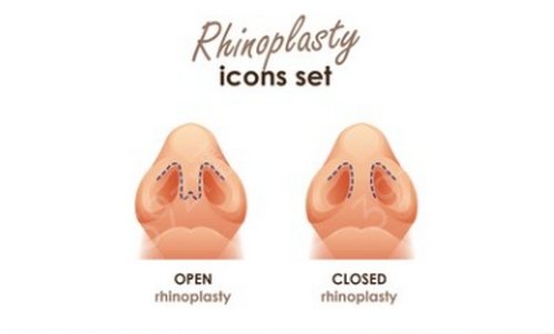 北京航天总医院整形外科价格表，附隆鼻案例分享