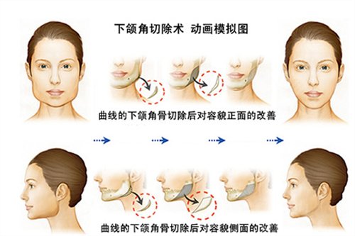 济南艺星整形医院去下颌骨*果展示，2020价格表全新曝光