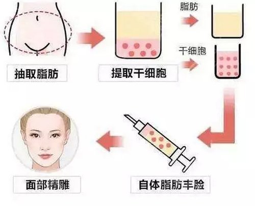 惠州伊丽莎白医院面部脂肪填充案例&价格表收费标准曝光