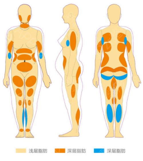 吸脂有几种方式？一次可以吸几个部位？