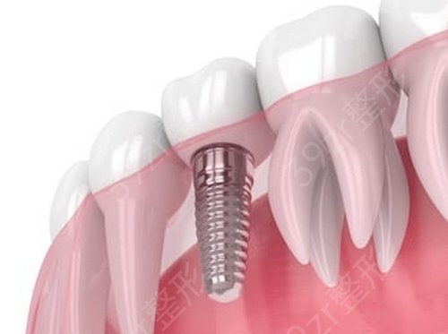 你们知道种植牙有哪些利与弊吗？